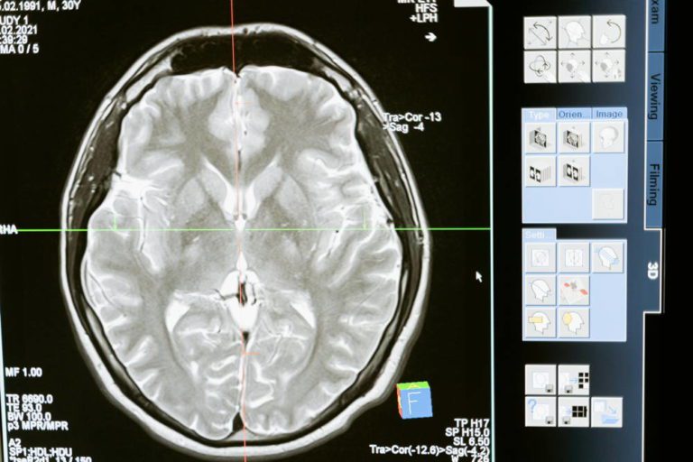 scan d'un cerveau